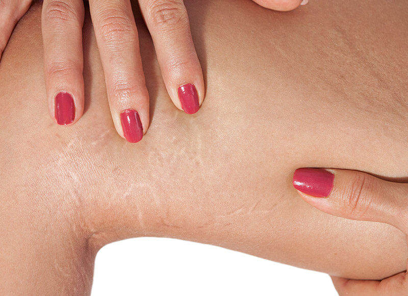 RF mikroigłowa rozstępy