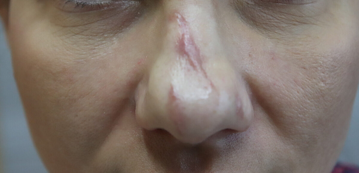 blizna na nosie