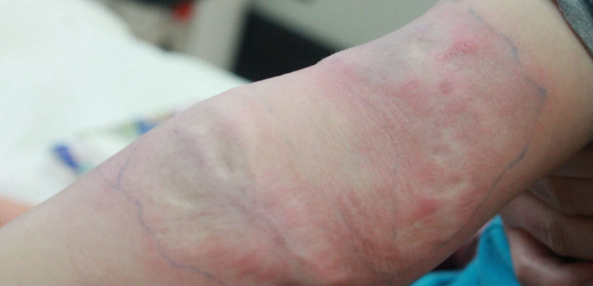 blizna po oparzeniu u dziecka