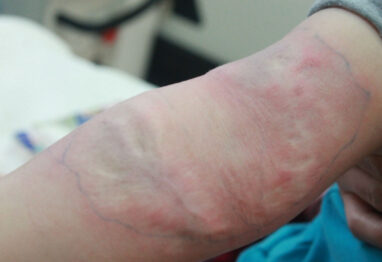 blizna po oparzeniu u dziecka