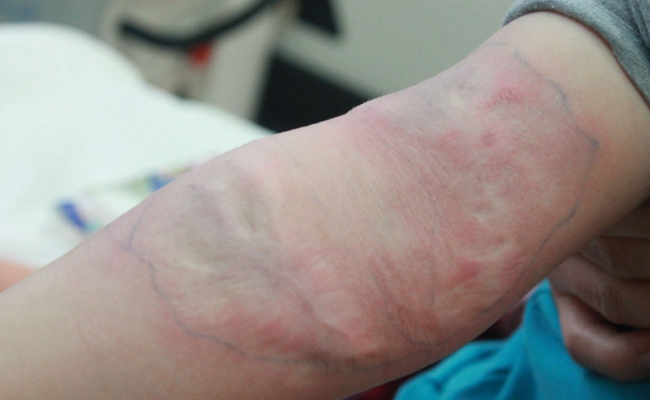 blizna po oparzeniu u dziecka