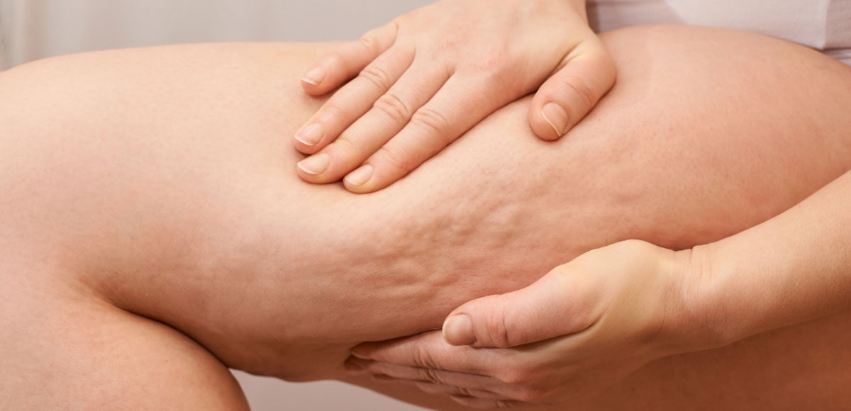 cellulit, na udzie
