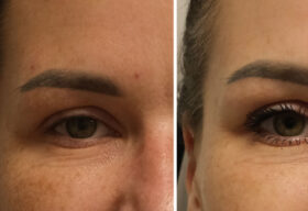 Oko przed i po zabiegu