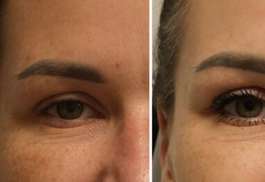 Oko przed i po zabiegu