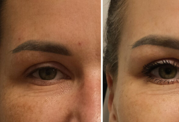 Oko przed i po zabiegu