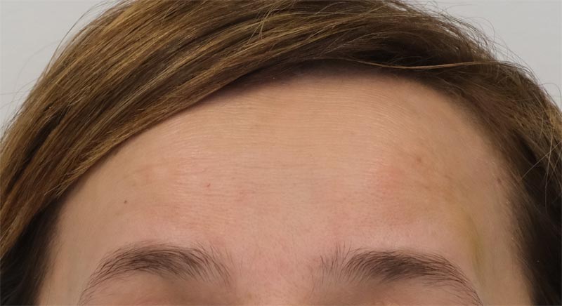 Czoło po leczeniu przebarwień