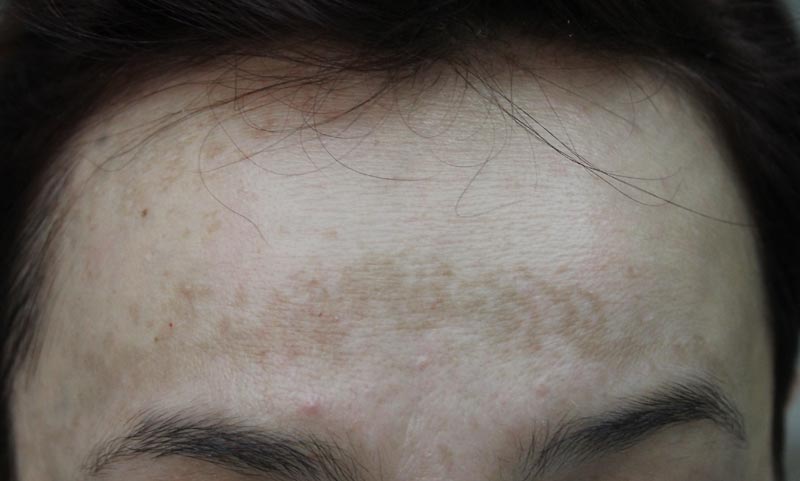 przebarwienia na czole