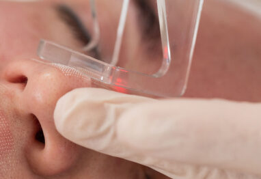 powikłania po laserze frakcyjnym