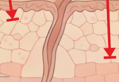 laser tulowy a frakcyjny CO@