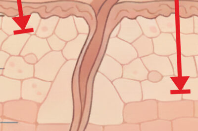 laser tulowy a frakcyjny CO@