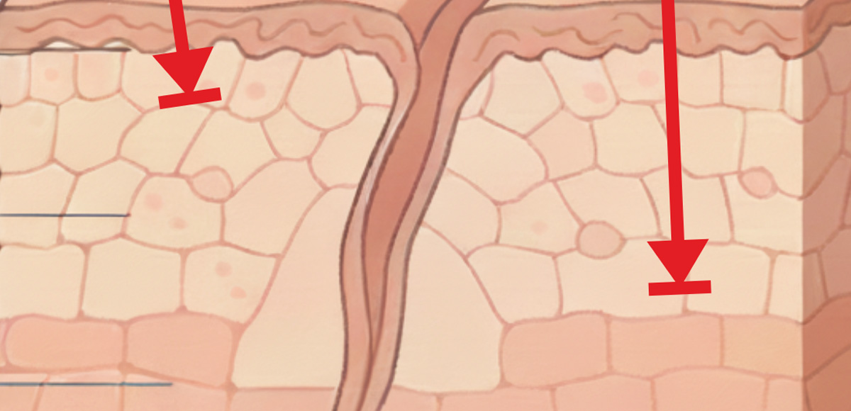 laser tulowy a frakcyjny CO@