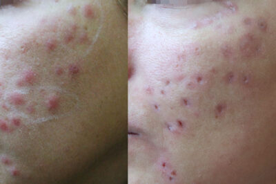 powikłanie po mezoterapii