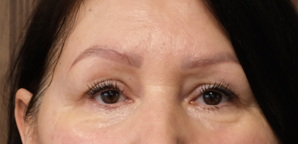 Rok walki z powikłaniem: Finał historii z kwasem polimlekowym pod oczami