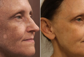 przebarwienia na twarzy