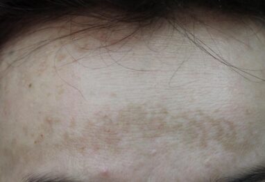 przebarwienie na czole