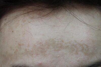 przebarwienie na czole