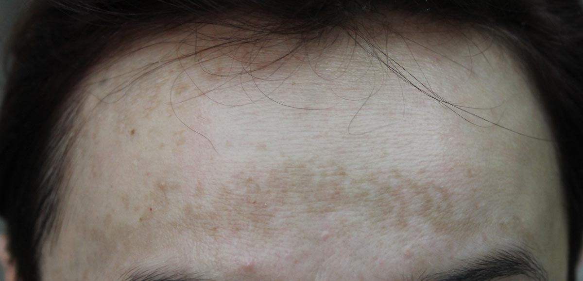 przebarwienie na czole