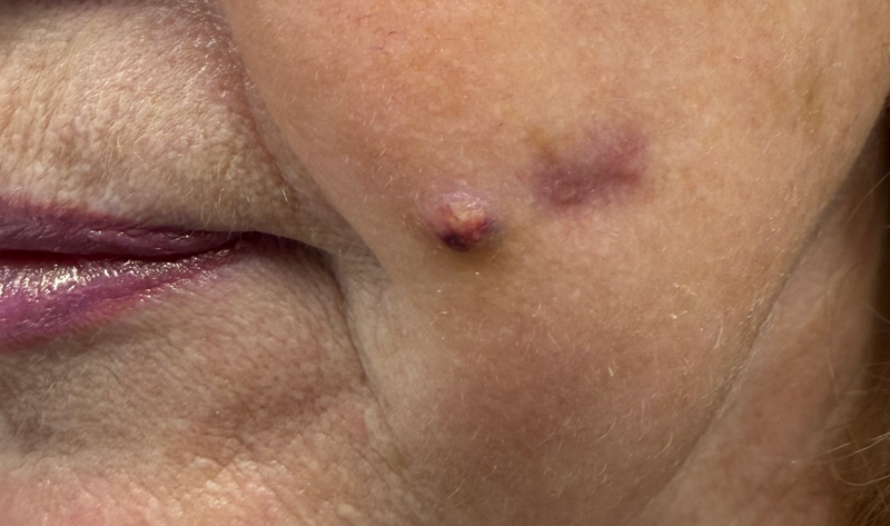 powikłanie po niciach