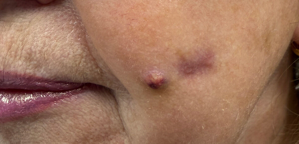 ropień na policzkach