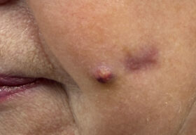 ropień na policzkach