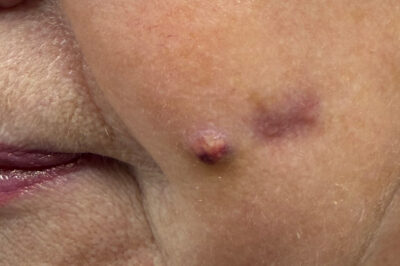 ropień na policzkach