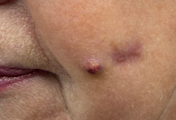 ropień na policzkach