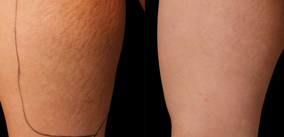 rozstępy - efekty przed i po