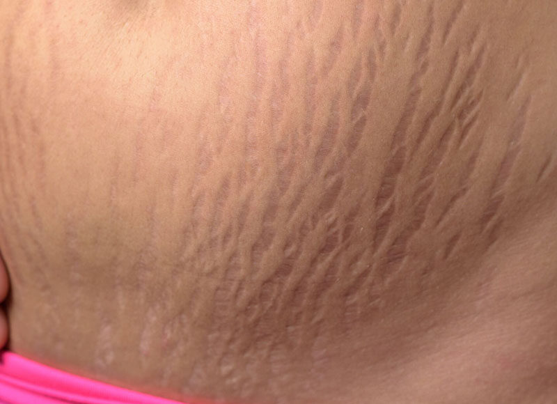 usuwanie rozstępów